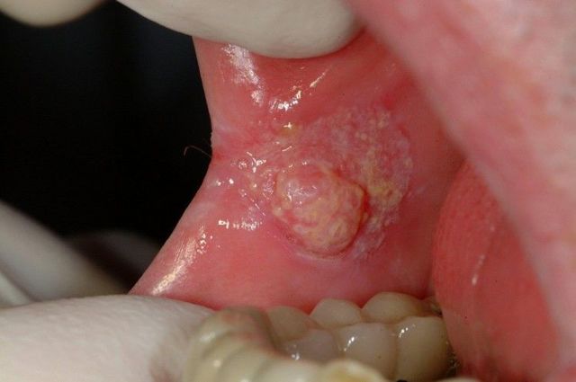 Удаление папиллом в полости рта, на деснах, слизистой и щеках