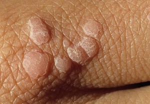 Плоскоклеточные папилломы кожи