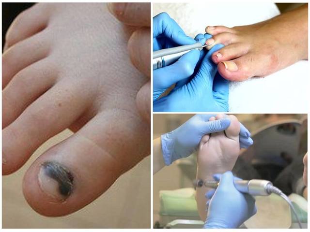 Педикюр при грибке ногтей: лечебный, медицинский, в салоне