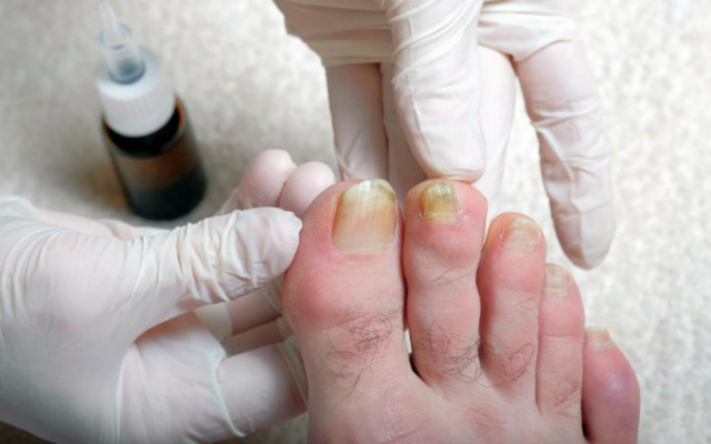 Желтые ногти на ногах - причины и лечение