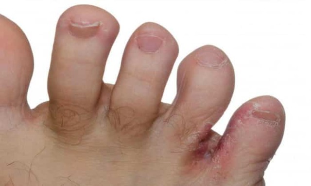 Грибок между пальцами ног: лечение - препараты недорогие, но эффективные